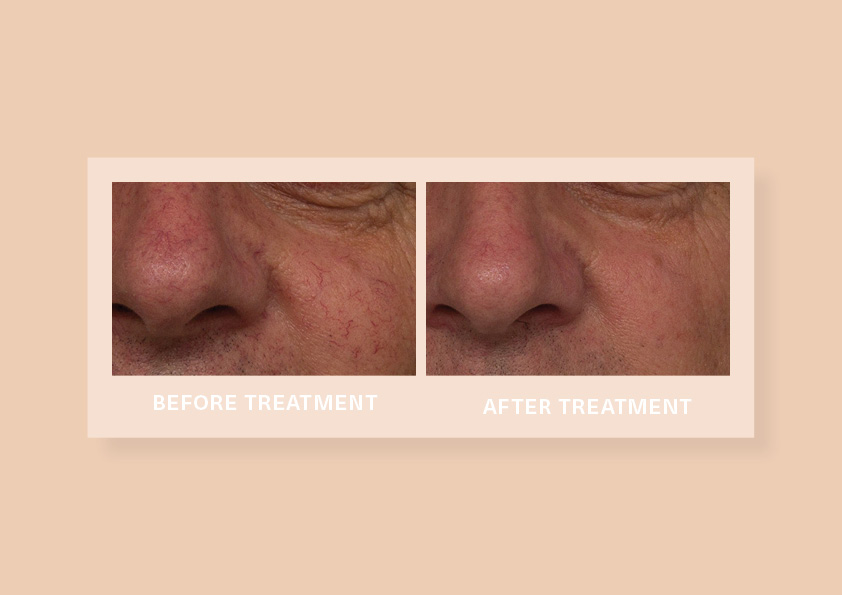 Vascular lesions (broken capillaries)