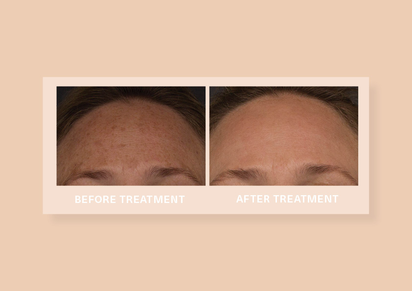 Hyperpigmentation (age spots)