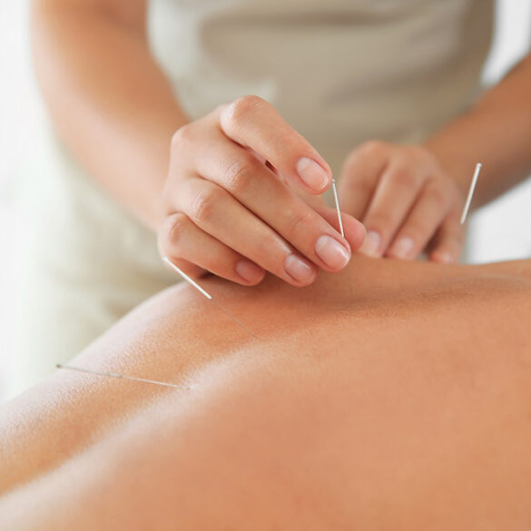 Acupuncture