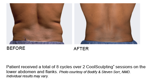 coolsculpting coolsculpting