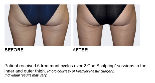 coolsculpting coolsculpting