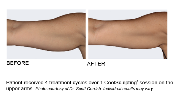 coolsculpting coolsculpting