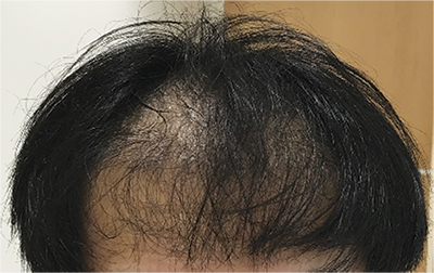 hair transplant