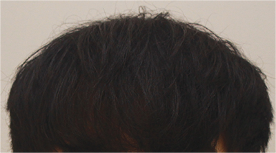 Hair Transplant