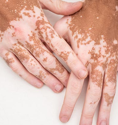 pigmentation