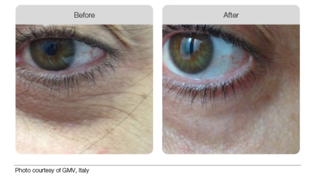 Plasma Beofre & After 01