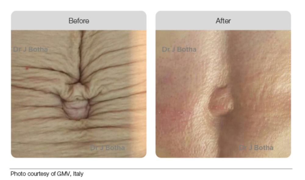 Plasma Beofre & After 02