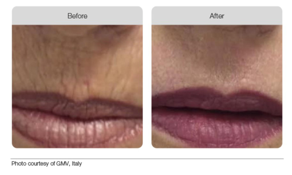 Plasma Beofre & After 03