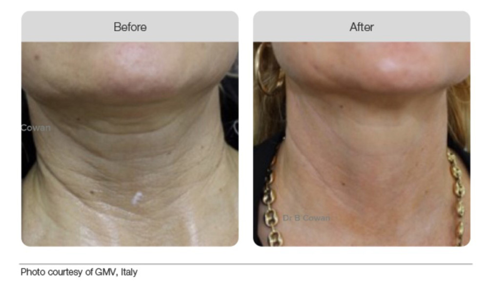 Plasma Beofre & After 04