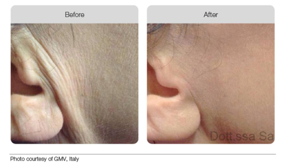 Plasma Beofre & After 06
